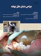 جراحی دندان عقل نهفته