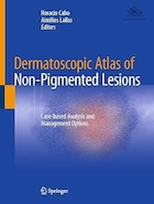 Dermatoscopic Atlas of Non-Pigmented Lesions: Case-based Analysis and Management Options | اطلس درماتوسکوپی ضایعات غیر رنگدانه: تجزیه و تحلیل مبتنی بر مورد و گزینه های مدیریت