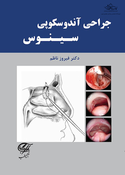 جراحی آندوسکوپی سینوس