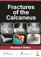 Fractures of the Calcaneus | شکستگی استخوان پاشنه