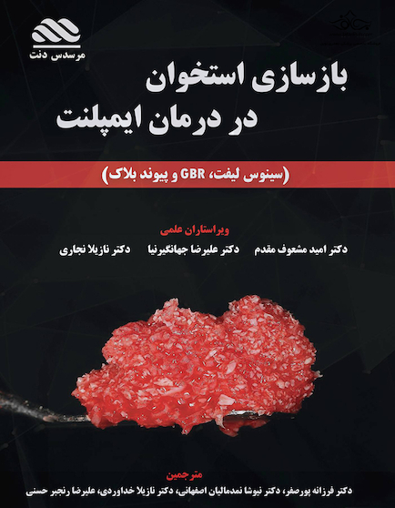 بازسازی استخوان در درمان ایمپلنت
