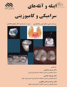 اینله و آنله های سرامیکی و کامپوزیتی