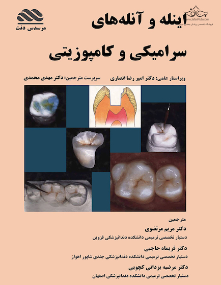 اینله و آنله های سرامیکی و کامپوزیتی