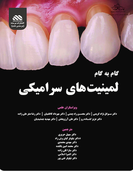 گام به گام لمینیت های سرامیکی