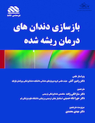 بازسازی دندان های درمان ریشه شده